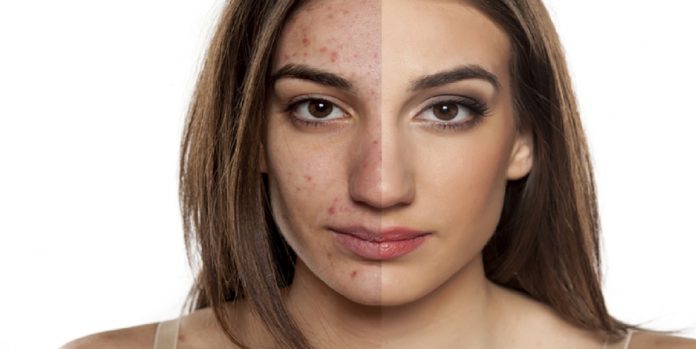 skincare-acne-laser