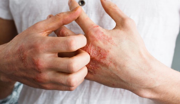 eczema-apps